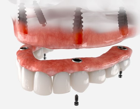 All on Four Dental Implants