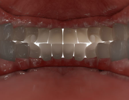 Arched Implant