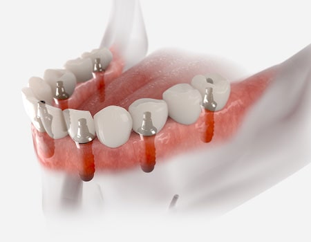 Implant Stabilized Dentures