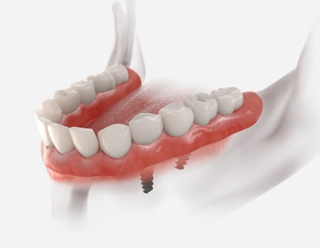 Multi Implant Bridges