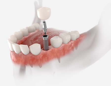 Single Dental Implant Crown